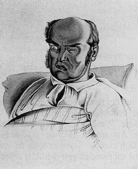 Porträt eines Kranken, das Carl Sandhaas für das medizinische Werk von Professor Baumgärtner (1839) malte